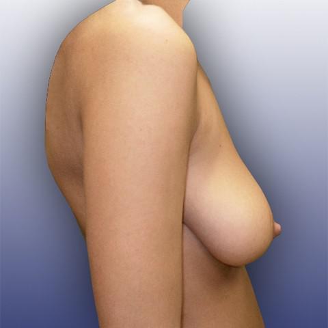 Plasticka operace prsou před