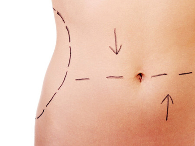 Miniabdominoplastika Miniabdominoplastika