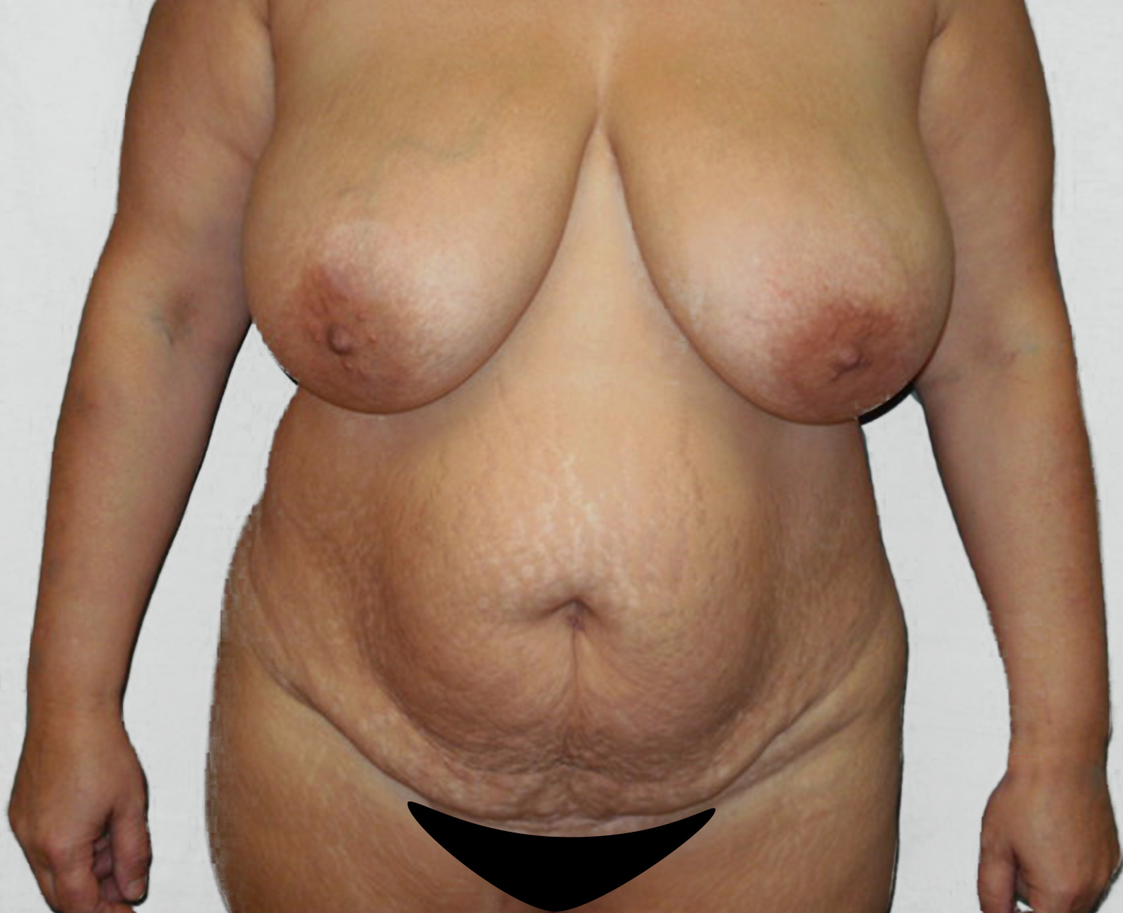 Abdominoplastika břicha před zákrokem