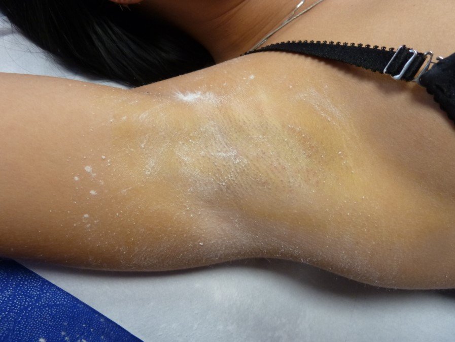 odstranění pocení