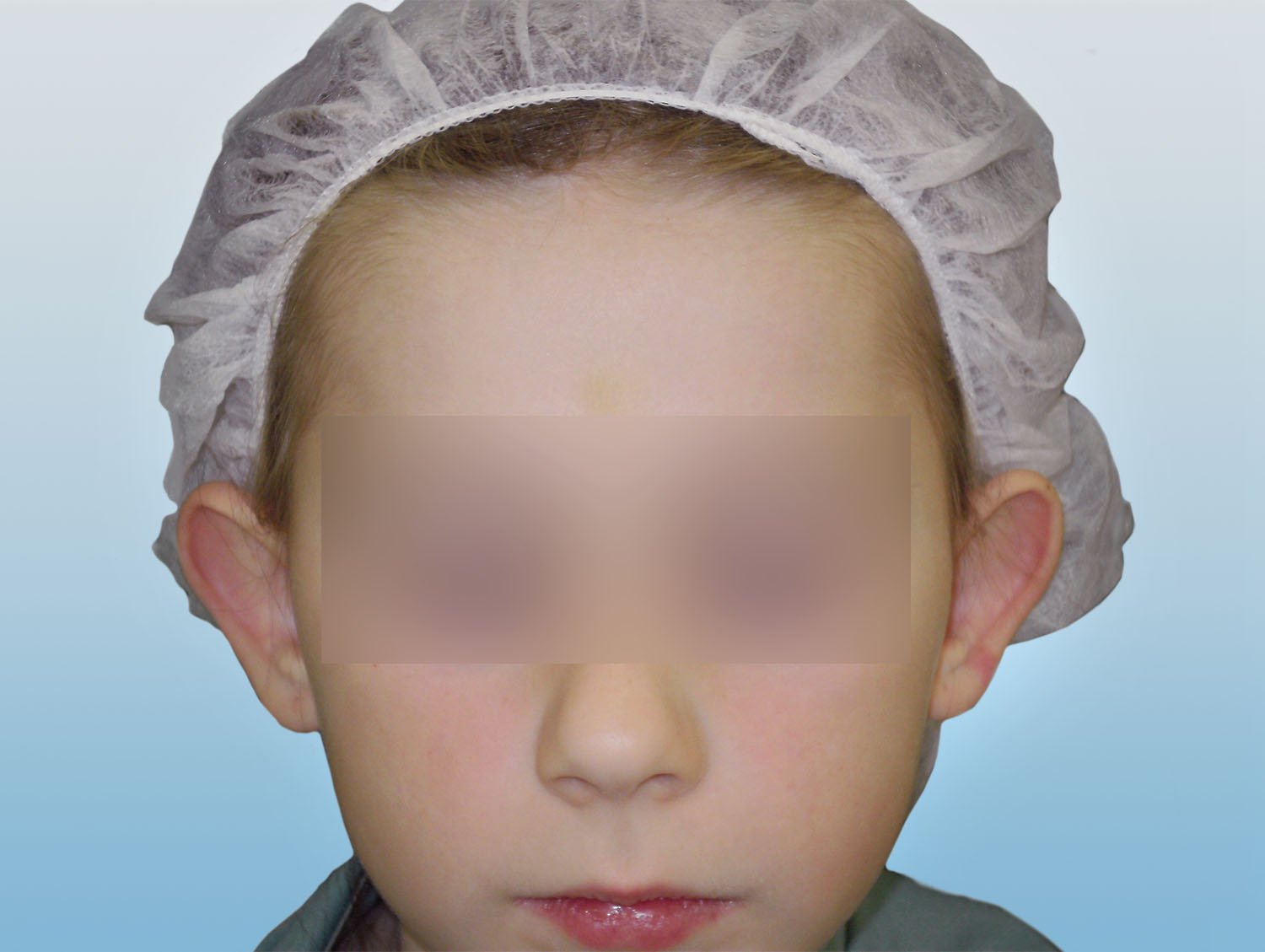 Plastika uší - po zákrokuOtoplastika u dětí - před zákrokem