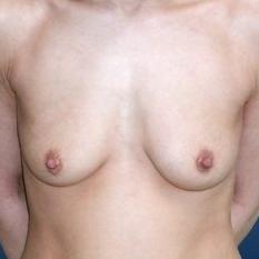 Plastické operace prsou - před