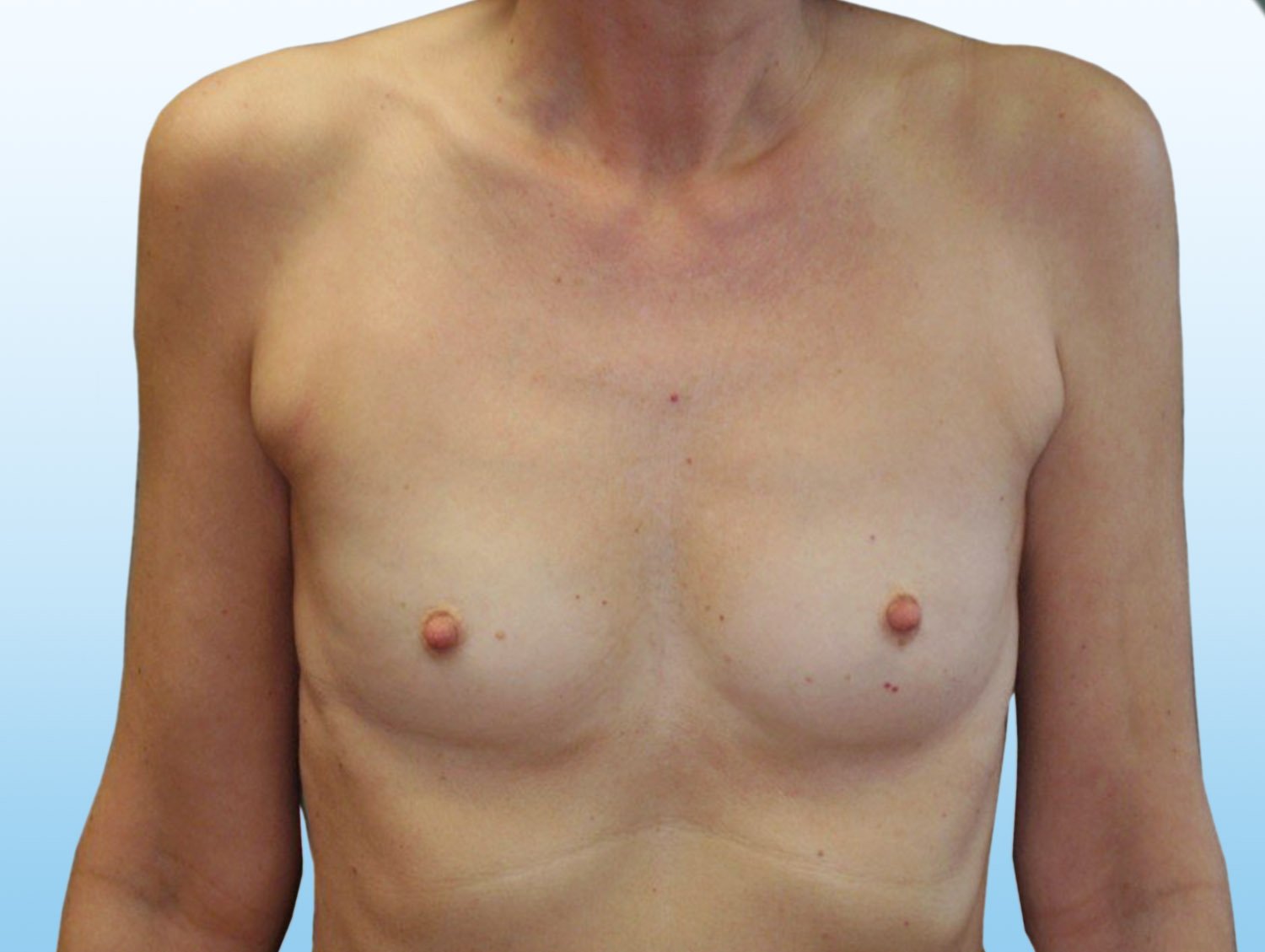 Výsledek zvětšení prsou pomocí augmentace - před zákrokem