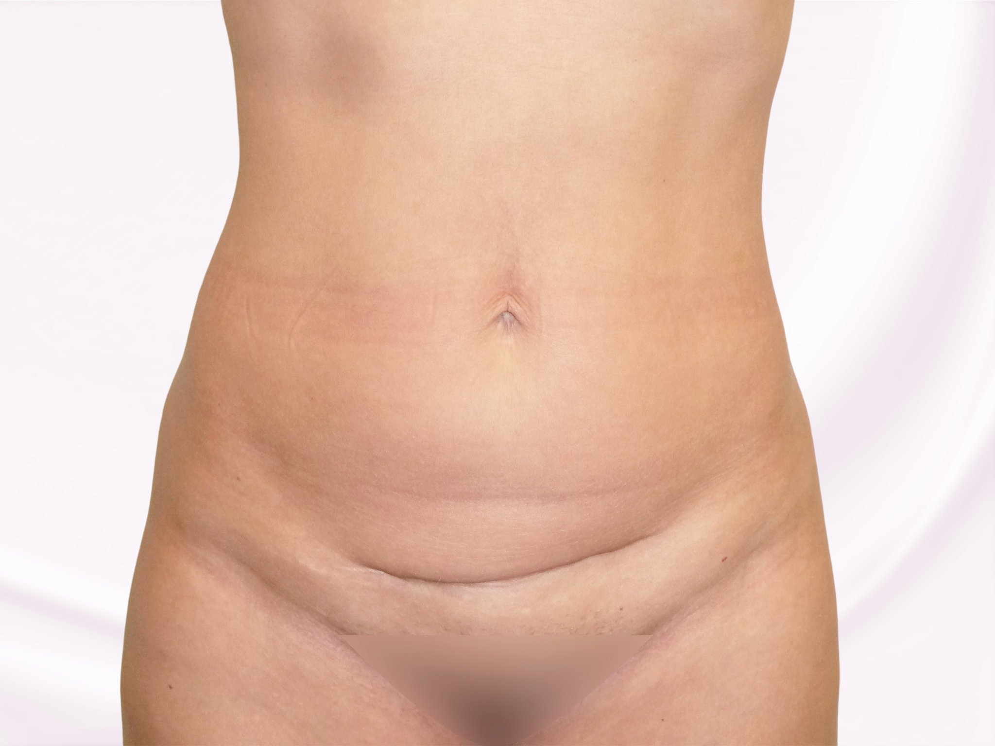 Abdominoplastika břicha fotografie před zákrokem
