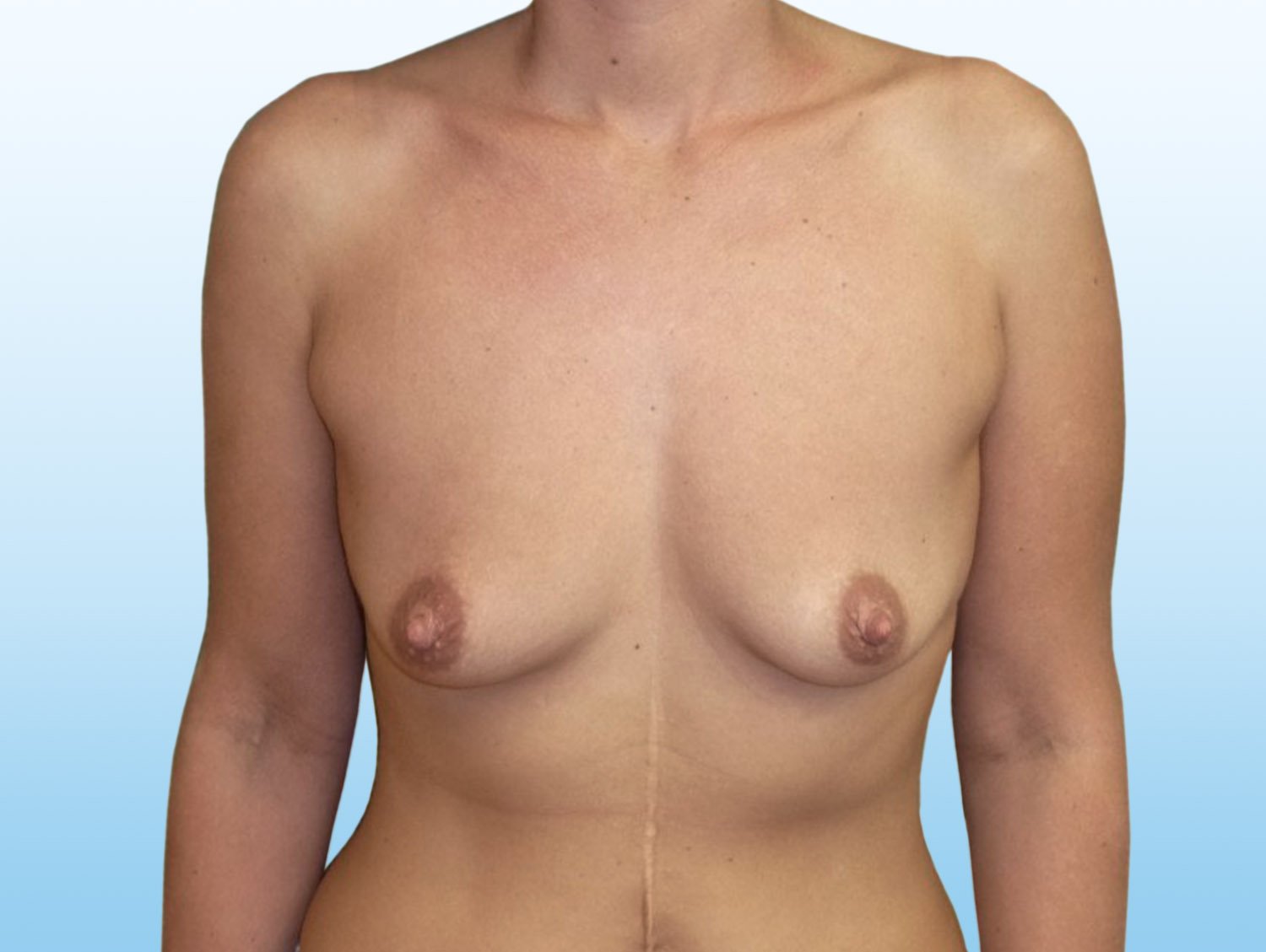 Výsledek zvětšení prsou pomocí augmentace - před zákrokem