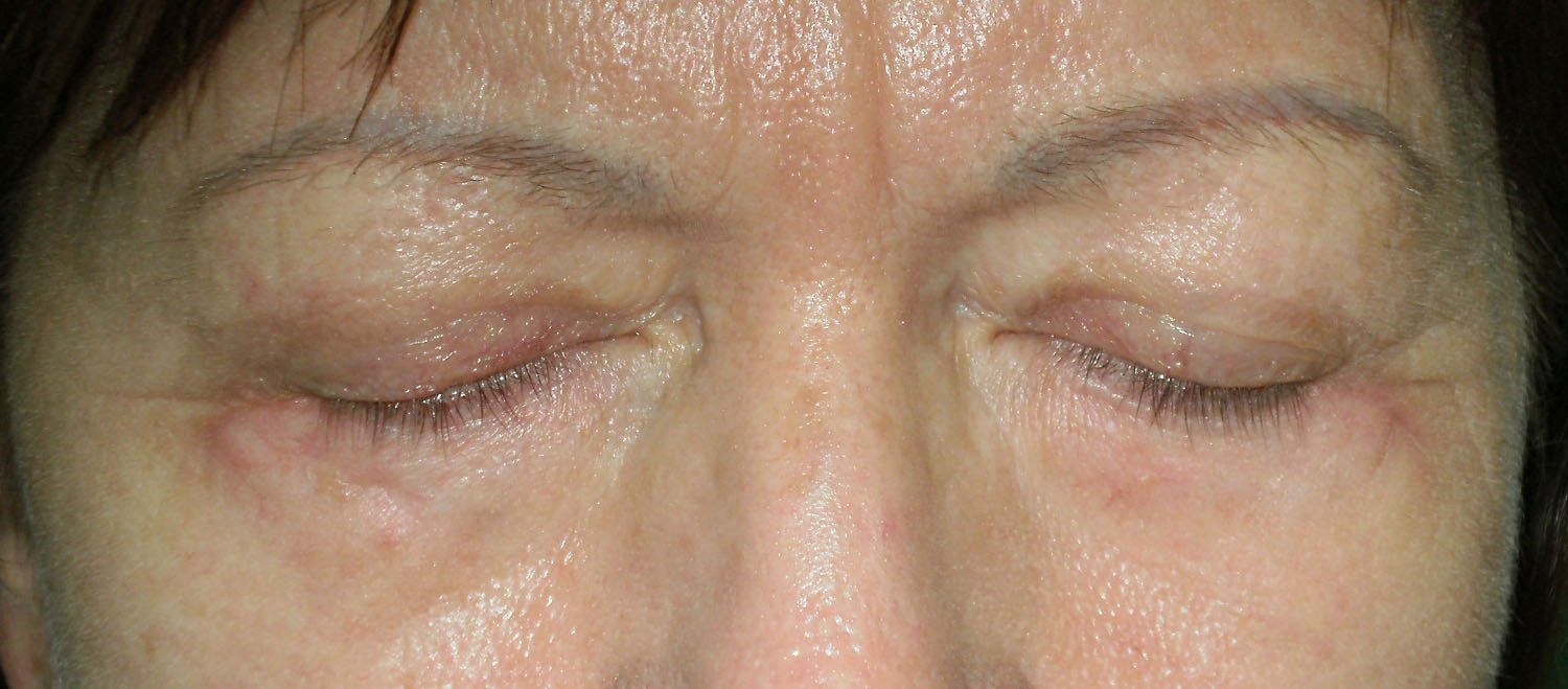 Operace dolních víček - po zákroku - zavřené oči