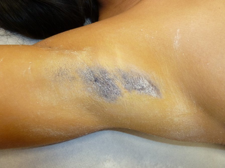 odstranění pocení