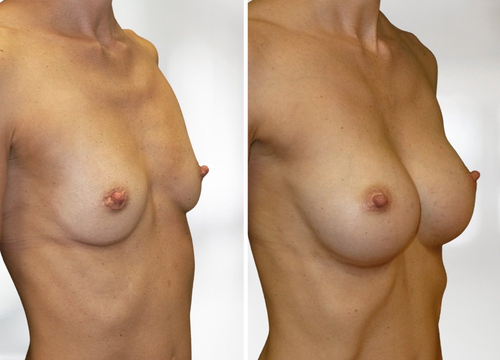 Augmentace před a po - zvětšení prsou Plasticare