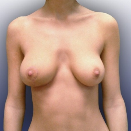 Mammaplastika (modelace prsou, pozvednutí a zpevnění prsou) - PO zákroku