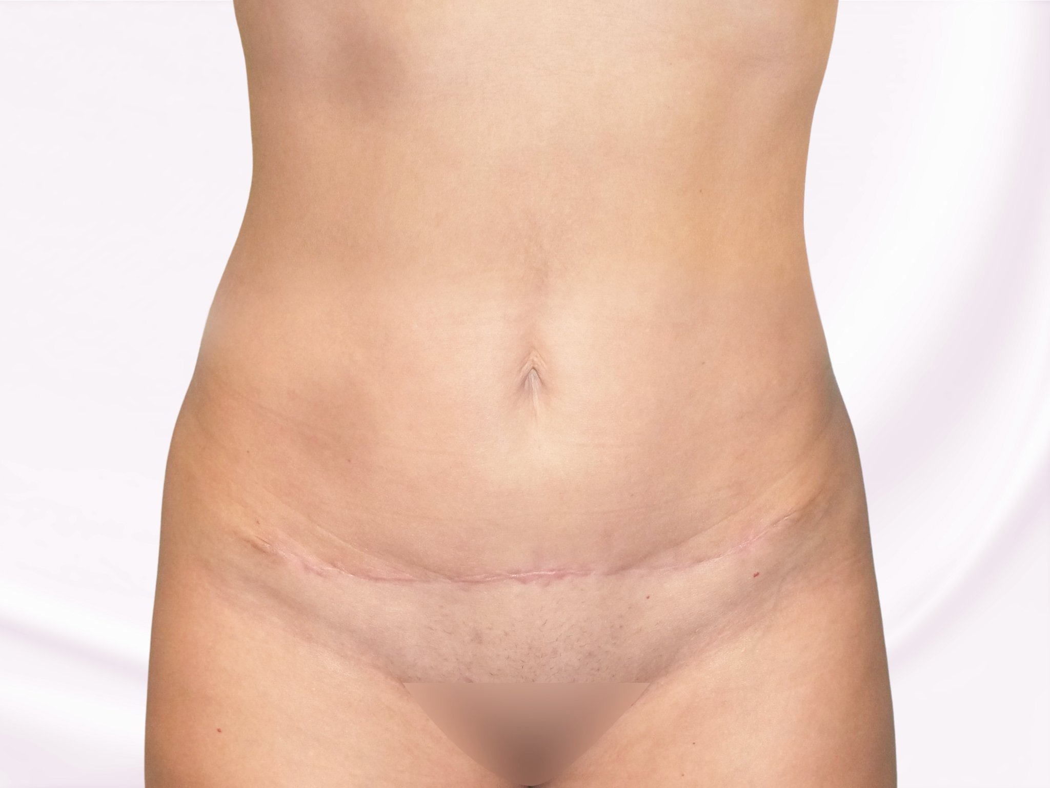 Abdominoplastika břicha fotografie po zákroku