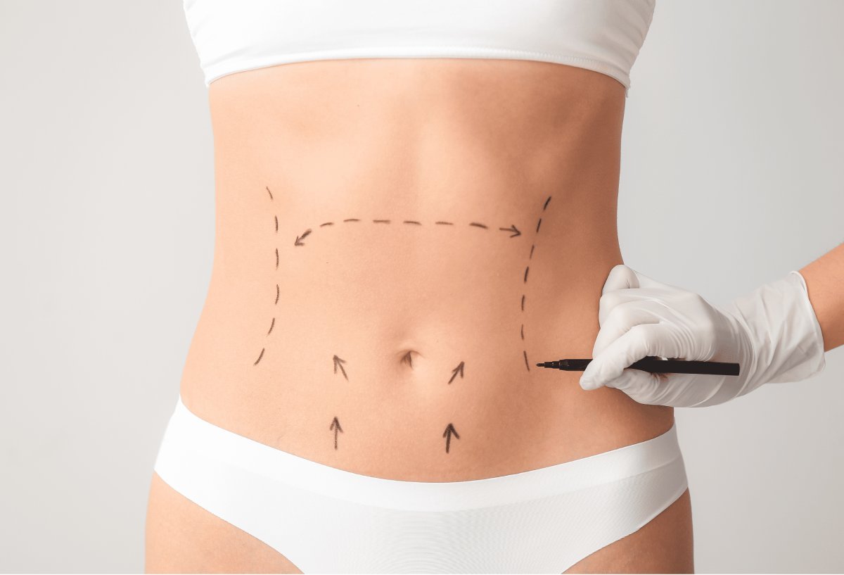 Miniabdominoplastika