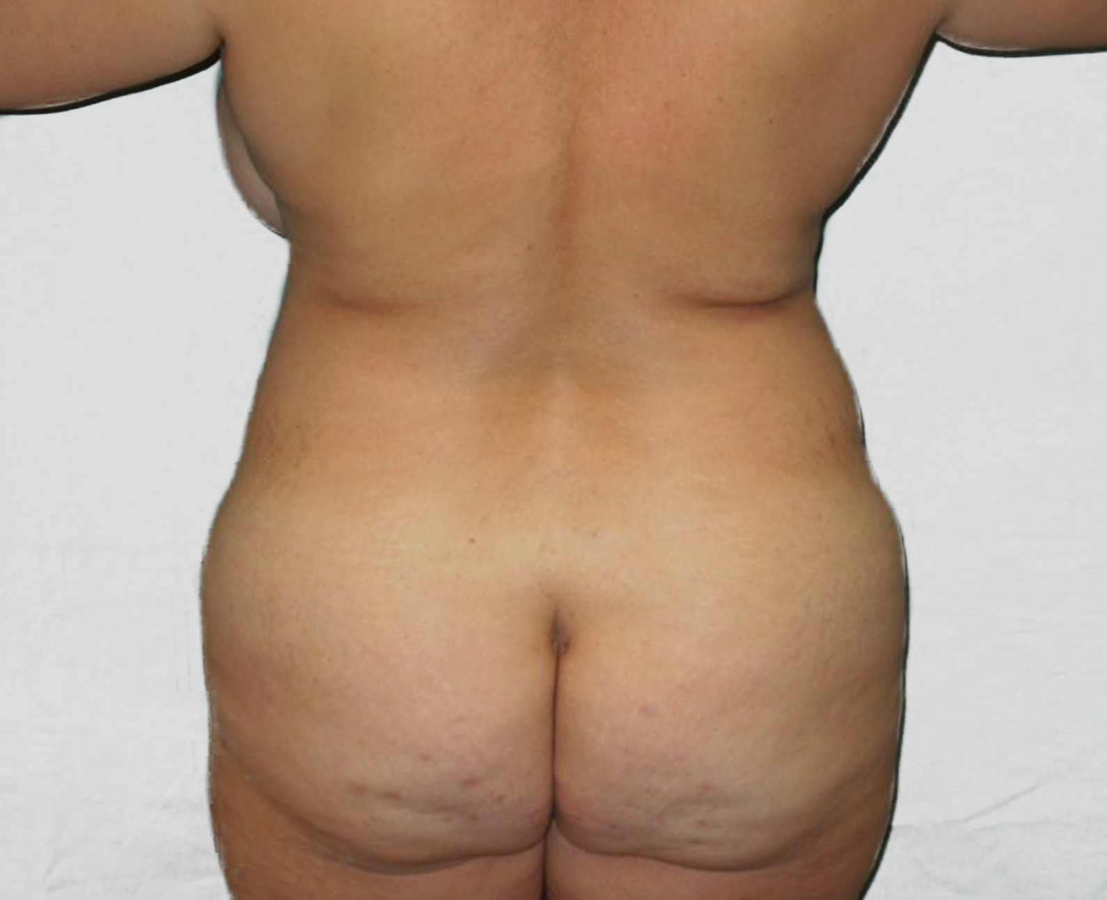 Abdominoplastika před zákrokem zezadu