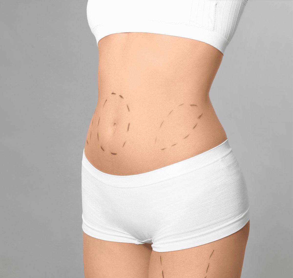 Miniabdominoplastika