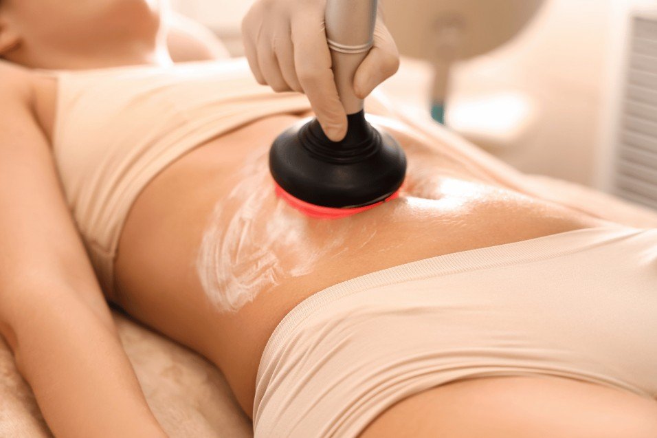 Biostimulační laser používáný na odstranění strií Biostimulační laser používáný na odstranění strií