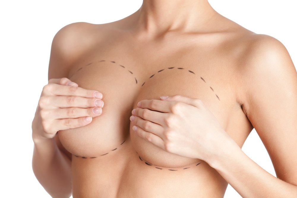 Zvětšení prsou implantáty, augmentace