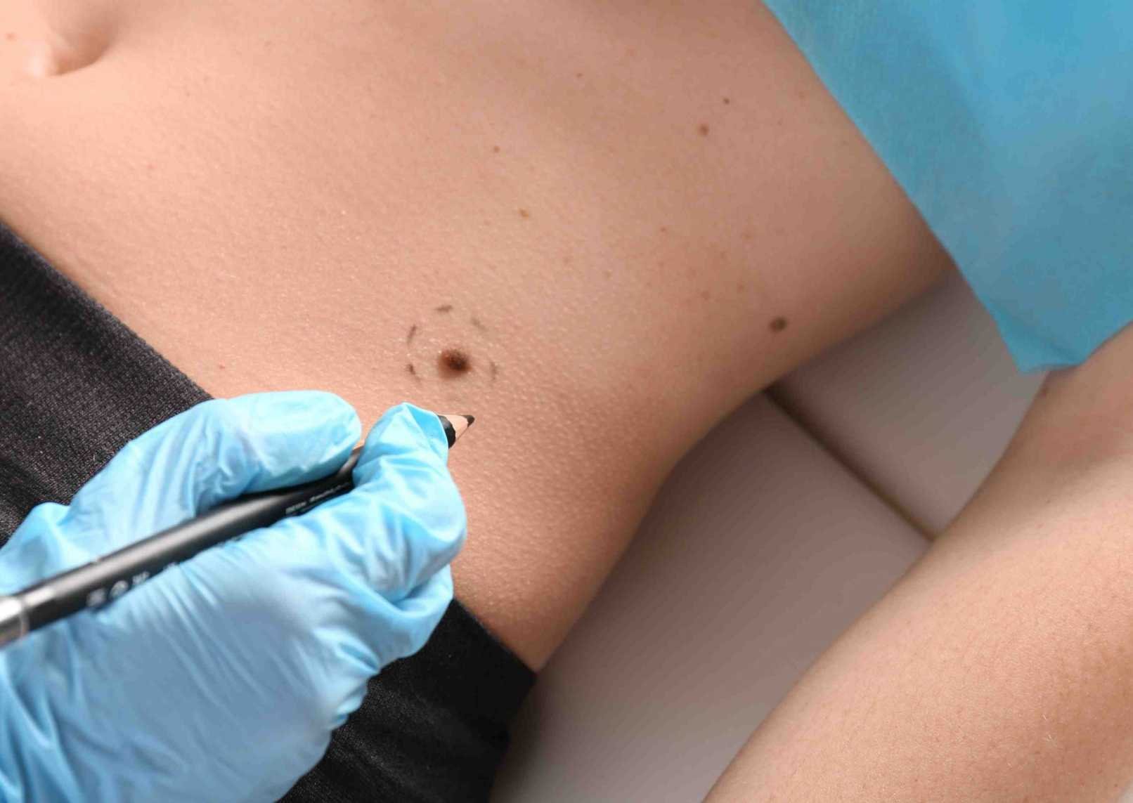 Lékař označuje mateřské znaménko na kůži Lékař označuje mateřské znaménko na kůži