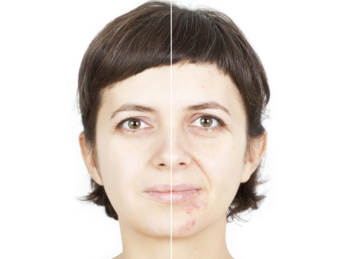 Odstranění staré jizvy - jizva na obličeji