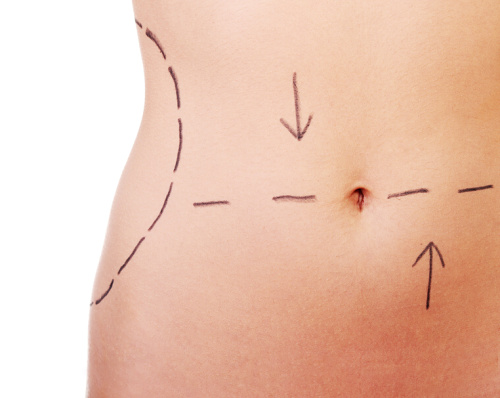 Abdominoplastika břicha - odstranění povislé kůže na břiše