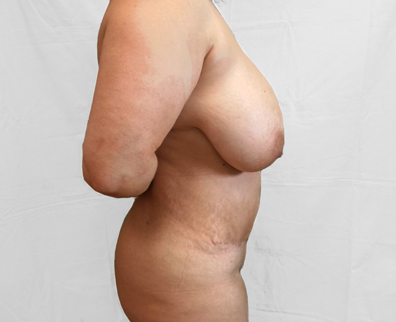 Abdominoplastika po zákroku zboku