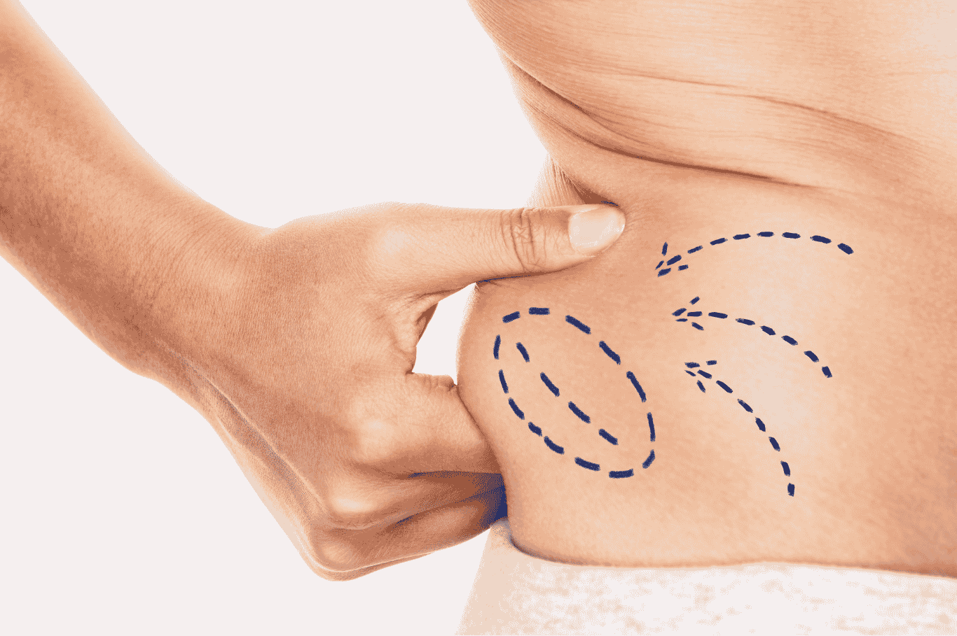 Zvýraznění tukového nadbytku k liposukci Zvýraznění tukového nadbytku k liposukci