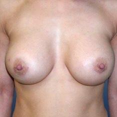 Plastické operace prsou - po